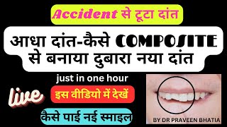 Accident से टूटा आधा दांत-LIVE देखें कैसे COMPOSITE से बनाया दुबारा नया दांत -DR PRAVEEN BHATIA