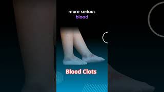 What Causes Blood Clots In The Legs of The Elderly