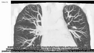 Hyperinflated lungs compress the heart during expiration in COPD - Sub ID 145599