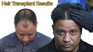 BEST HAIR TRANSPLANT RESULTS IN Just 7 Months | Hair Transplant Cost in India | High Grade Baldness