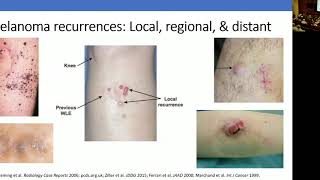Natural History of Melanoma, Surveillance for Metastatic Disease