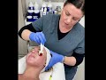 Microneedling (2mm) for Acne Resurfacing with Vitamin Infusion