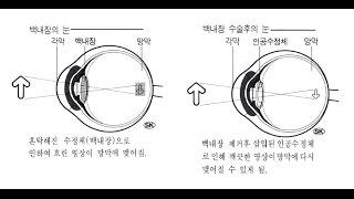 LA안과 - 백내장