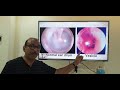 Bullous Myringitis (Hindi) Patient teaching programme