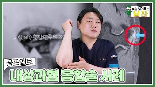 안쪽은 수술하면 안된다고?!｜골프엘보(내상과염) 봉합술 케이스｜수술 읽어주는 남자👨‍⚕️