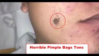 Horrible Pimple Bags Tons Pimple Removal Out The Face | Pimples Extraction (#9)