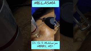 Laser treatment for Melasma || Hyperpigmentation || Lentigens || Nd Yag pico laser || #drgsmukherjee