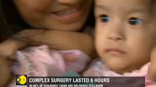 Conjoined Bhutanese twin girls separated in six-hour surgery