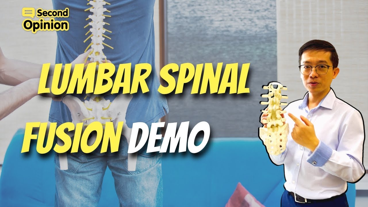 Lumbar Spine Fusion рџ ґdemo Youtube