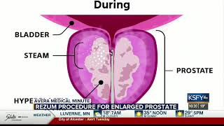 Rezum procedure for enlarged prostate less invasive with great results - Medical Minute