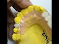 flexible partial denture by prof dental lab w 25 years experience online order www.rosenthaldent.com