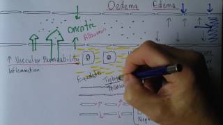 Capillaries 7, Edema can be exudates or transudates