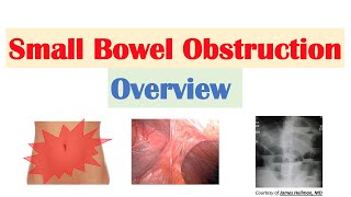 Small Bowel Obstruction (SBO) | Risk Factors, Causes, Signs & Symptoms, Diagnosis, Treatment