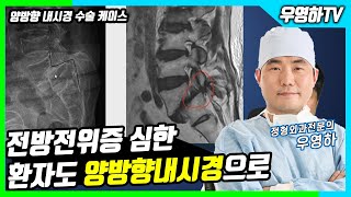 [ 양방향내시경 , 양방향척추내시경 , 양방향내시경수술 , 양방향 내시경 척추수술 ] 척추전방전위증을 가진 환자도 양항뱡내시경으로 해결(부산큰병원 우영하 원장)