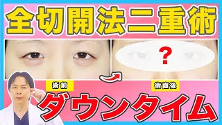 【二重整形】全切開法二重術のダウンタイム|術後の腫れはいつまで続く？