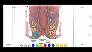 perianal abscess