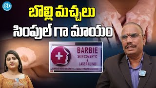 బొల్లి మచ్చలు సింపుల్ గా మాయం | Bolli Machalu | Vitiligo | BARBIE Skin Cosmetic & Laser Clinic