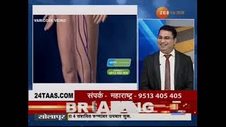 Namma Homeopathy Dr Santhosh Varicose veins