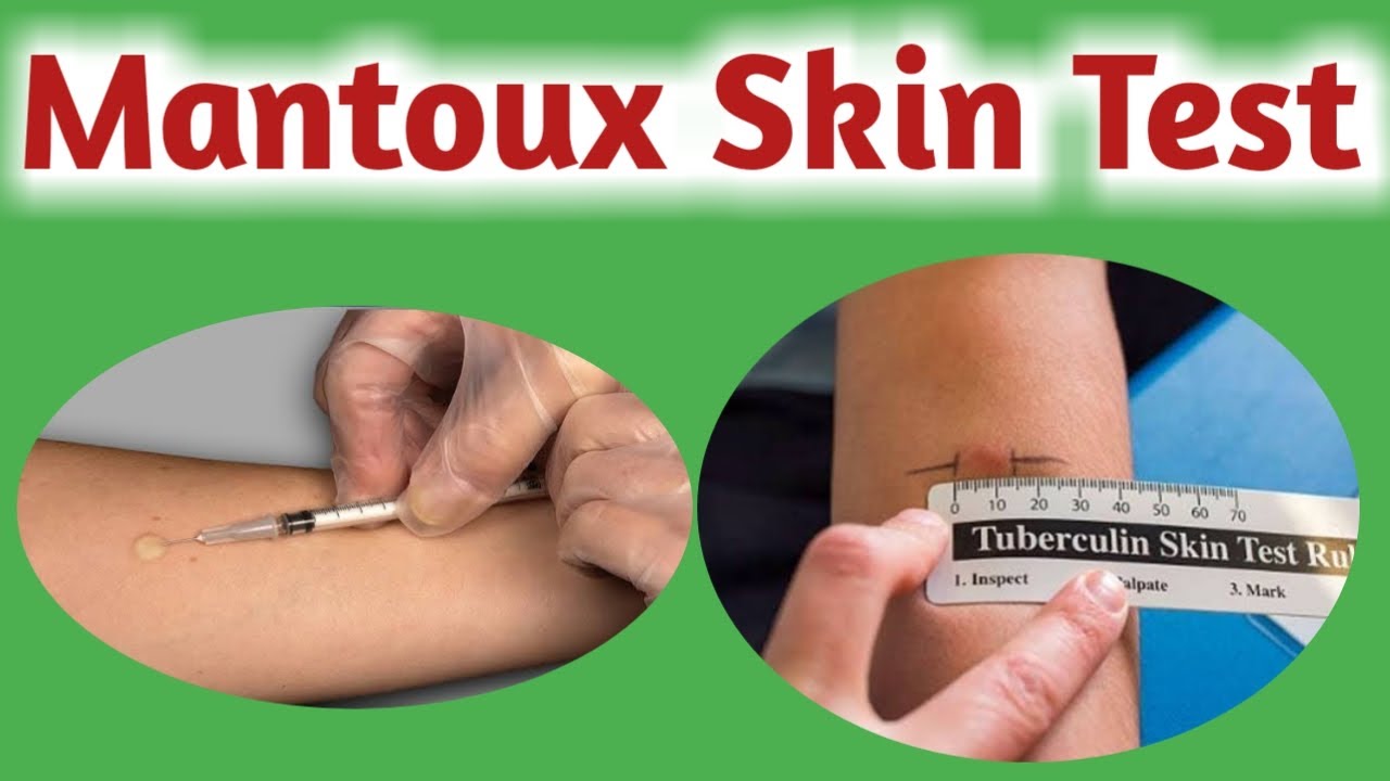 Mantoux Test Principle, Procedure, Interpretation And