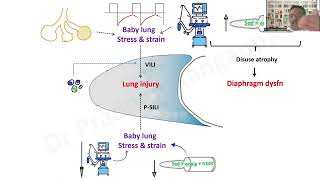 Lung & Diaphragm protective ventilation Overview_Dr Pradeep Rangappa