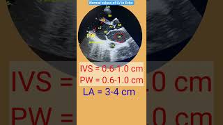 Normal values of IVS, LA, LV size in Echo l #echo #shorts