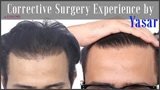 Corrective Hair Transplantation | Hairline Correction I 7 months update @EugenixHairSciencesofficial