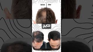 اوعي تستخدم المينوكسيديل ! Dont Use Minoxidil #hairstyle #hair #haircut #haircare # #minoxidil