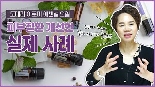 ★ 도테라 아로마 에센셜 오일 ★ 피부의 알레르기, 화상에도 도테라 오일이 도움이 될까요?