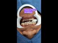 process of braces installation ការពត់ធ្មេញ shorts