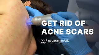 How to Treat Acne Scarring with Dr. T