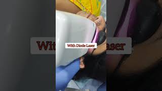 You Won't Regret getting This Laser Treatment for Hair Reduction #laserhairremoval #bikaner