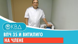 💣 ВПЧ 35 и витилиго на члене. Клинический случай №258