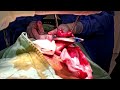 illeostomy reversal with stapplers colostomy typhoid surgeon surgeryrecovery surgerysuccess