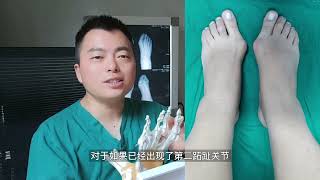 拇趾外翻，做了拇外翻手术其余关节疼痛是否也就都好了-hallux valgus