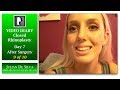 Closed Rhinoplasty Video Diary –After Removing Cast!, 1 Week After Surgery, 9 of 10