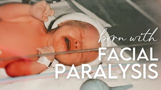 born with facial paralysis