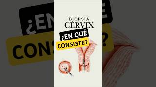 ¿Qué es una biopsia de cuello uterino? ¿EN qué consiste? #shorts