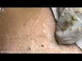 big cystic acne blackheads extraction blackheads u0026 milia whiteheads removal pimple popping