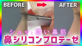 【施術密着】~シュッと鼻を高く~ 鼻整形でコンプレックスを解消！【鼻シリコンプロテーゼ Before-After】