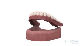 Soft denture - Lapointe dental centres