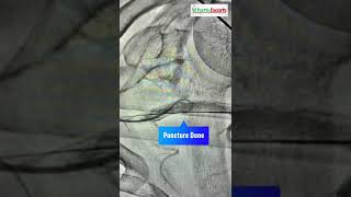 Transaxillary Cardiac Surgery