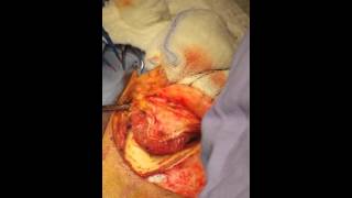 NICE AND CLEAN pterional CRANIOTOMY