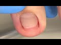 professional pedicure super deep ingrown nails【xue yidao pedicure】