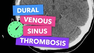 Dural venous sinus thrombosis - Radiopaedia's Emergency Radiology Course