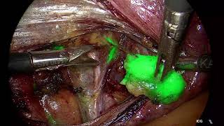 An awesome technique even made better - Introduction of 4K in ICG laparoscopy