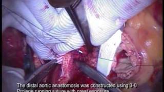 Total Aortic Arch Replacement with Estech stabilizer exposure