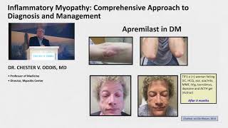 Best of ACR - Inflammatory Myopathy: Comprehensive Approach to Diagnosis and Management​