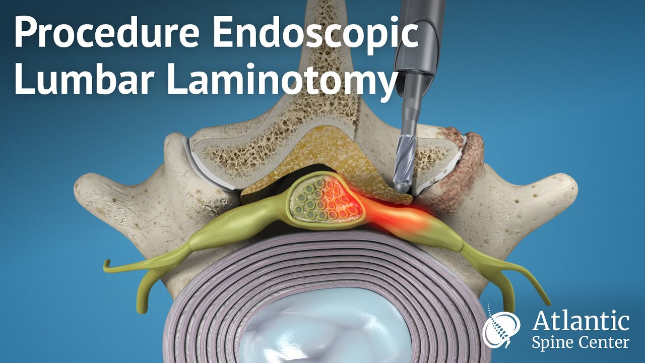 Lumbar Laminectomy With Fusion