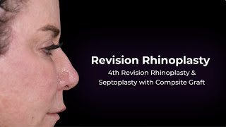 4th Revision Rhinoplasty \u0026 Septoplasty with Composite Ear Graft | Dr. Paul Nassif