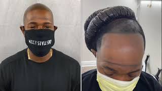 SCALP MICROPIGMENTATION / WILLY STYLE SMP